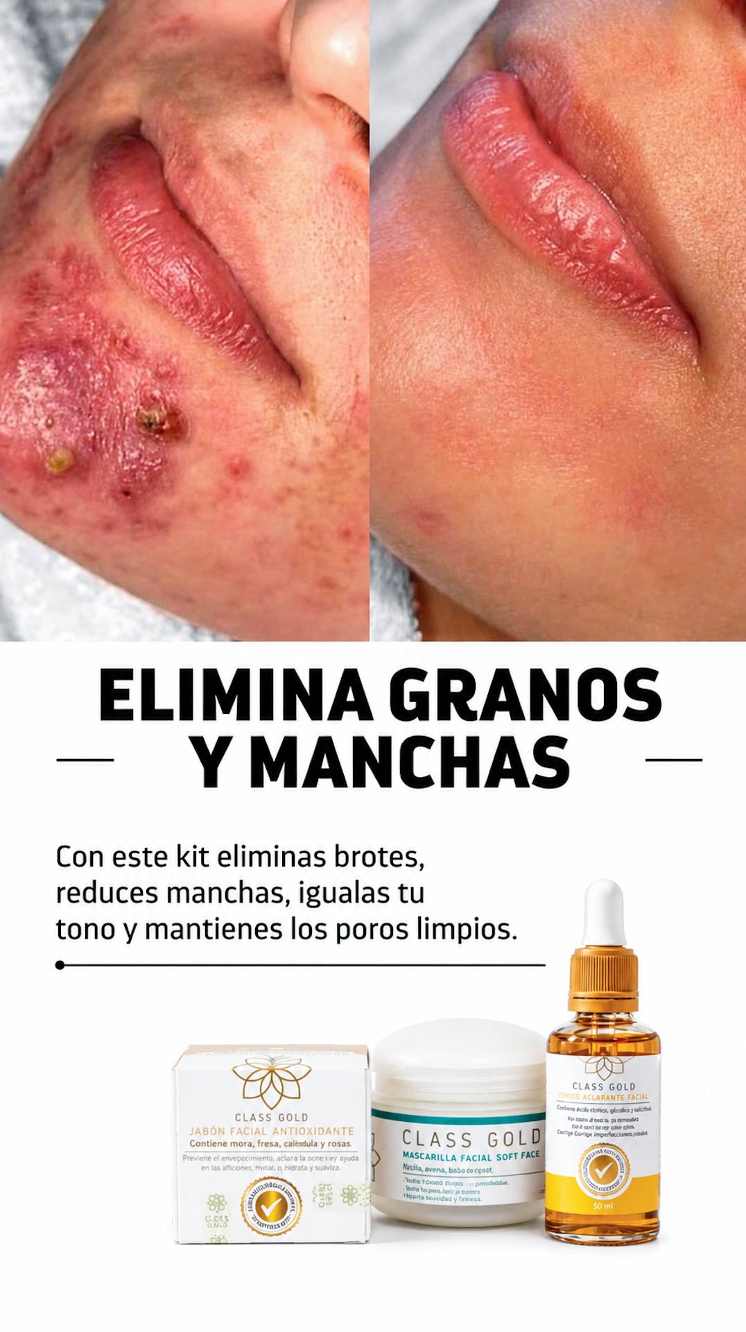 Kit Antigranos