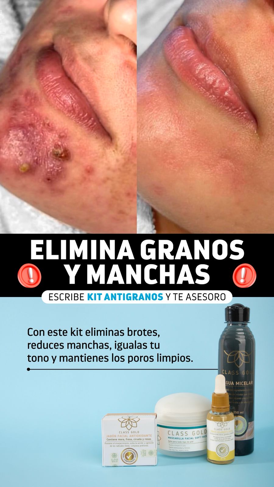 Kit antigranos